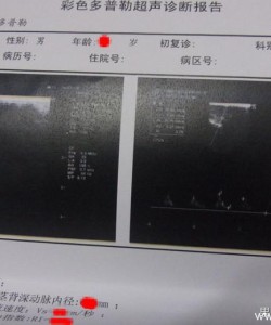 【真人体验】阴茎弯曲矫正手术过程及效果浅析